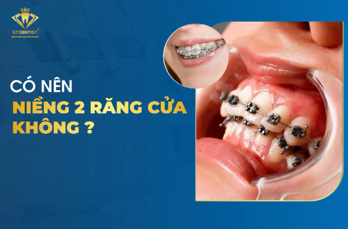 Niềng 2 Răng Cửa Có Hiệu Quả Không【BS.Giải Đáp】