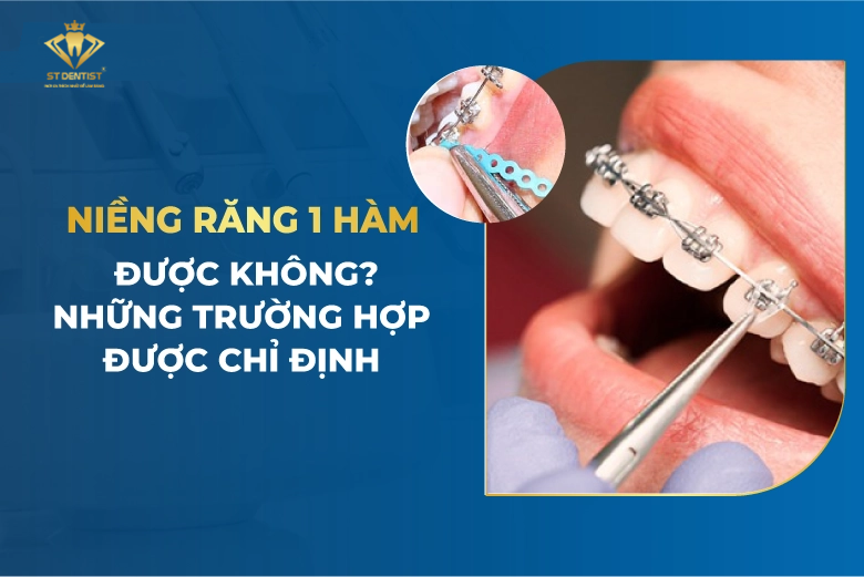 Niềng Răng 1 Hàm Có Được Không【BS.Giải Đáp】