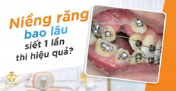 Niềng Răng Bao Lâu Siết 1 Lần【BS.Tư Vấn】