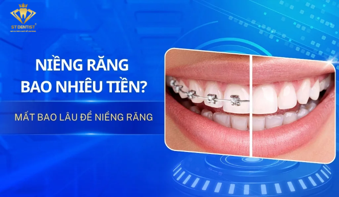 Niềng răng mất bao nhiêu tiền?