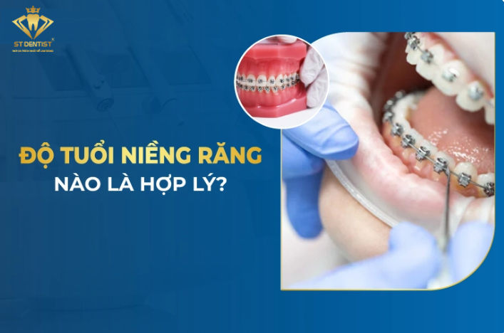 Niềng răng bao nhiêu tuổi thì phù hợp – Có nên niềng răng cho trẻ sớm hay không?