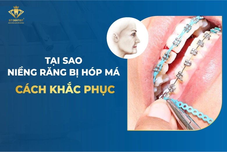 Niềng Răng Bị Hóp Má Do Đâu? Cách Khắc Phục【Tìm Hiểu】