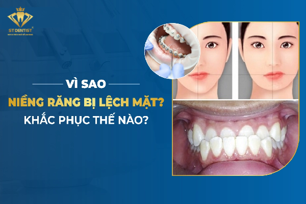 Niềng Răng Bị Lệch Mặt Là Do Đâu Và Cách Khắc Phục