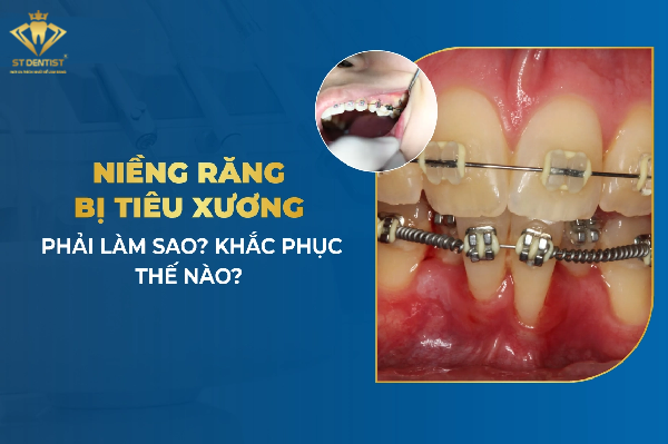 Niềng Răng Bị Tiêu Xương: Nguyên Nhân Và Cách Khắc Phục