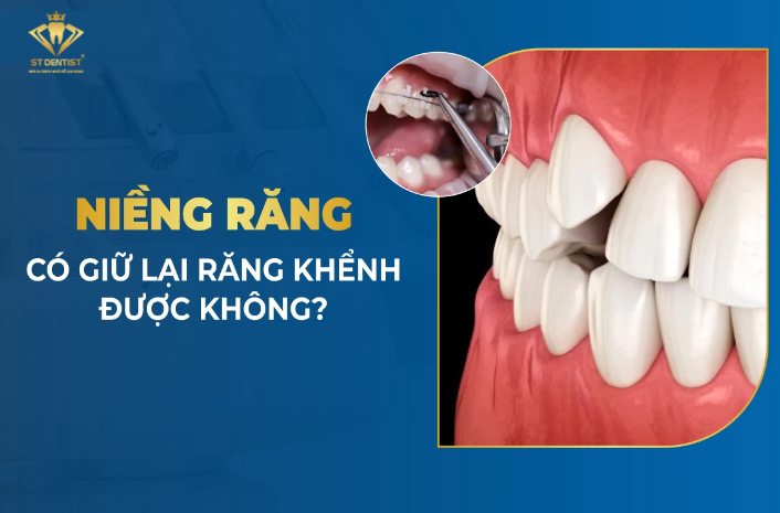 Niềng Răng Có Giữ Lại Răng Khểnh Được Không【Tìm Hiểu】