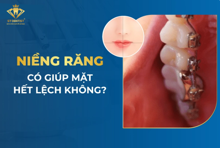 Niềng Răng Có Giúp Mặt Hết Lệch Không【Tìm Hiểu】