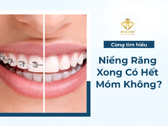 Niềng Răng Có Hết Móm Không【BS.Tư Vấn】