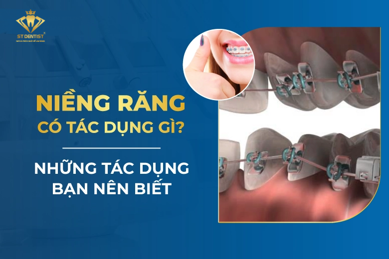 Niềng Răng Có Tác Dụng Gì【BS.Chia Sẻ】