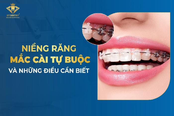 Niềng Răng Mắc Cài Tự Buộc Là Gì【Tìm Hiểu】