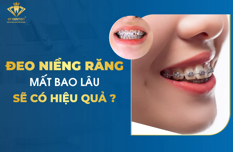 Niềng Răng Mất Bao Lâu Để Thấy Được Hiệu Quả【BS.Giải Đáp】