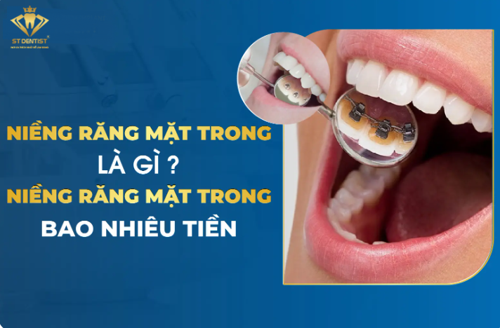 Niềng Răng Mặt Trong (Mặt Lưỡi) Là Gì【BS.Chia Sẻ】