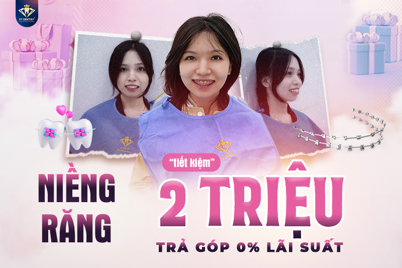 Niềng răng siêu tiết kiệm trả góp chỉ từ 2 triệu