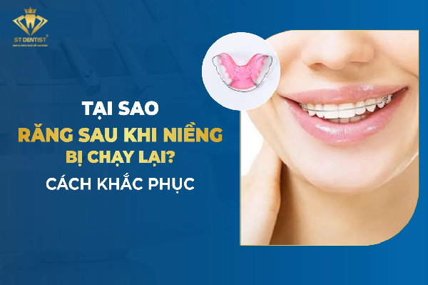 Niềng Răng Xong Có Bị Chạy Lại Không【Tìm Hiểu】