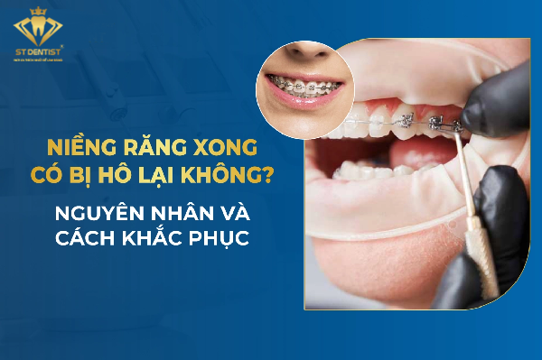 Niềng Răng Xong Có Bị Hô Lại Không【BS.Giải Đáp】