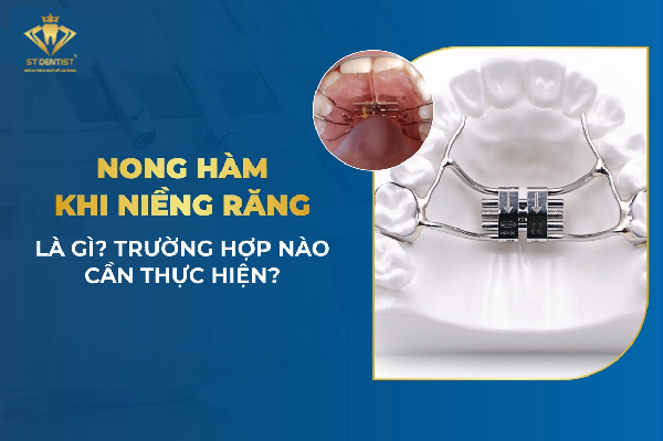 Nong Hàm Trong Niềng Răng Là Gì【BS.Giải Đáp】