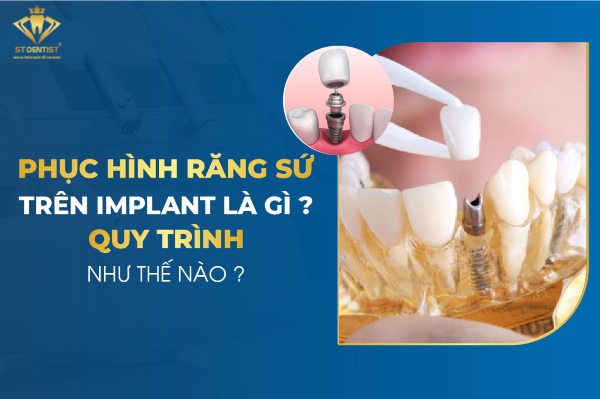 Phục Hình Răng Sứ Trên Implant Và Những Lưu Ý Quan Trọng