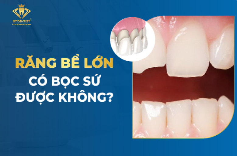 Răng Bị Bể Lớn Có Bọc Sứ Được Không【BS.Tư Vấn】