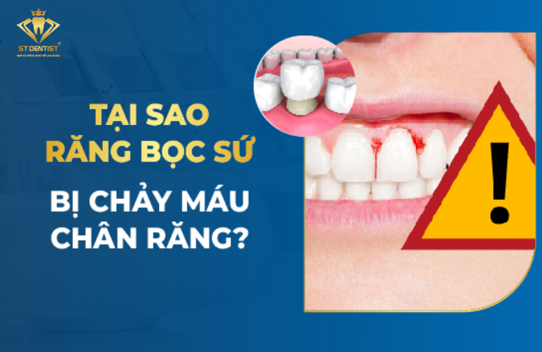 Răng Bọc Sứ Bị Chảy Máu Chân Răng Là Do Đâu【BS.Tư Vấn】