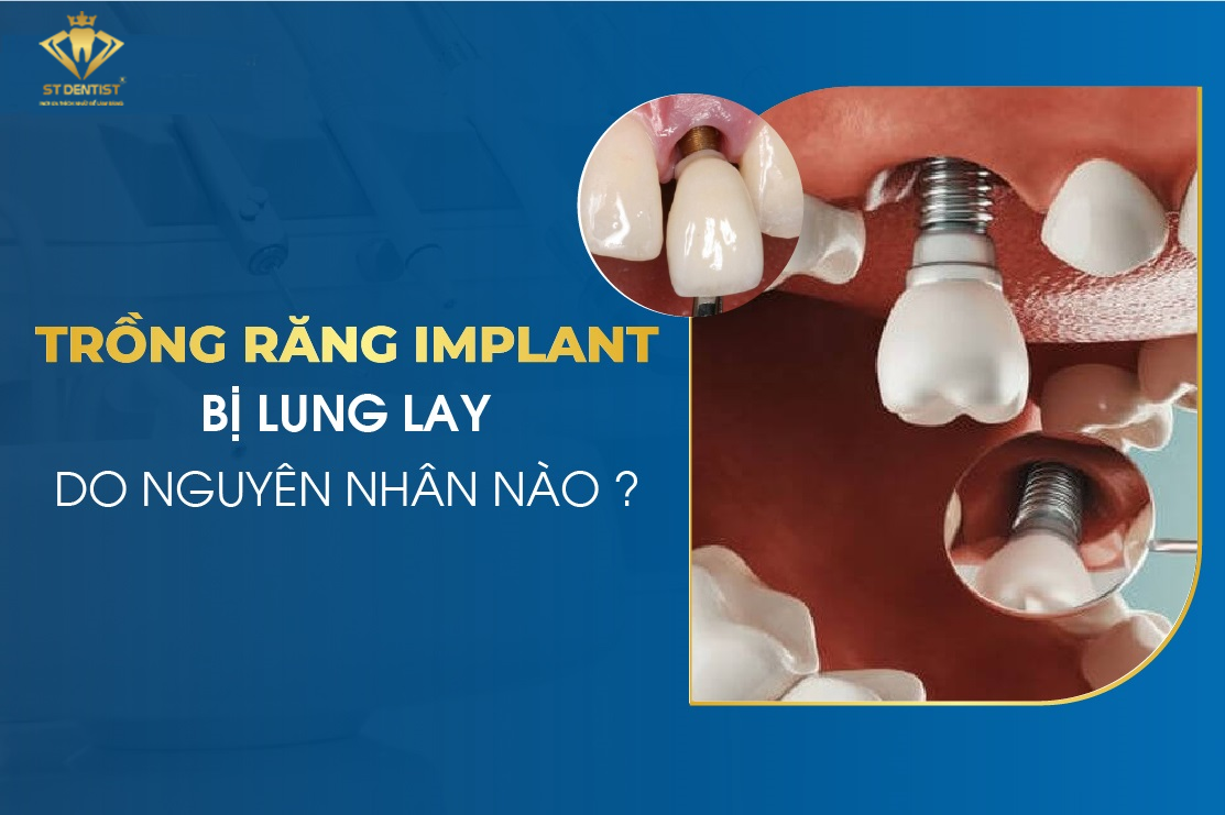 Răng Implant Bị Lung Lay Là Do Đâu【BS.Tư Vấn】