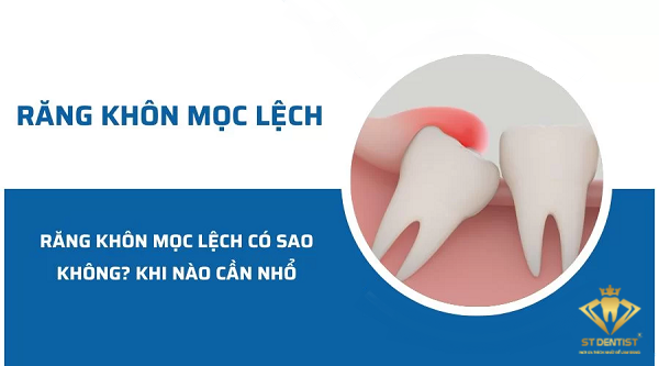 Răng Khôn Mọc Lệch Có Sao Không【BS.Tư Vấn】