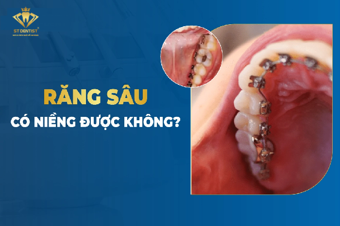 Răng Sâu Có Niềng Được Không【BS.Tư Vấn】