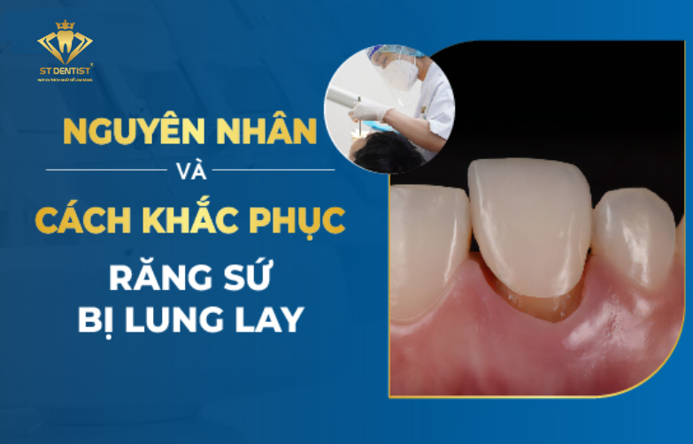 Răng Sứ Bị Lung Lay Phải Làm Sao【BS.Tư Vấn】