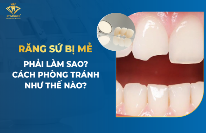 Răng Sứ Bị Mẻ Có Trám Được Không? Cách Khắc Phục