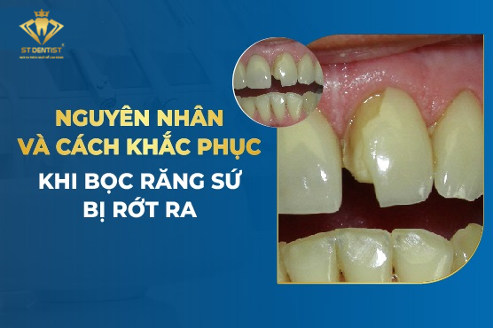 Bọc Răng Sứ Bị Rớt Ra Phải Làm Sao【BS.Tư Vấn】