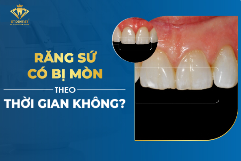 Răng Sứ Có Bị Mòn Không【BS.Giải Đáp】