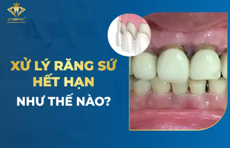 Răng Sứ Hết Hạn Phải Làm Sao【BS.Chia Sẻ】