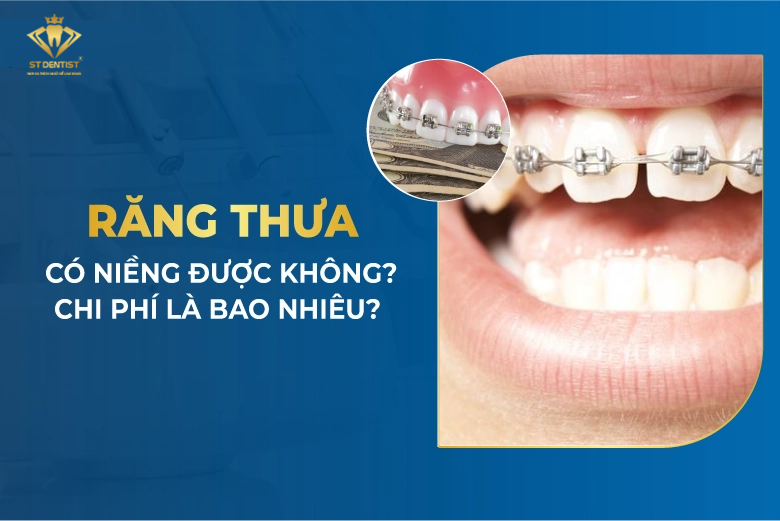 Răng Thưa Có Niềng Được Không【BS.Giải Đáp】