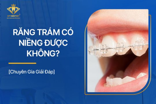 Răng Trám Có Niềng Được Không【BS.Tư Vấn】