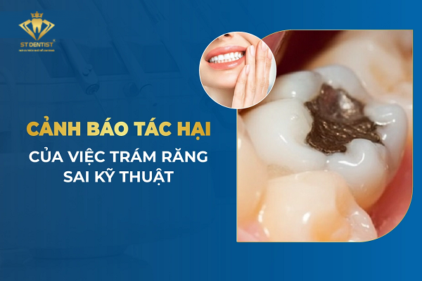 Tác Hại Của Trám Răng Sai Kỹ Thuật【Tìm Hiểu】