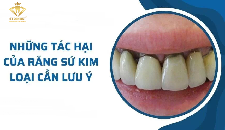 Tác Hại Của Răng Sứ Kim Loại【Bạn Cần Biết】