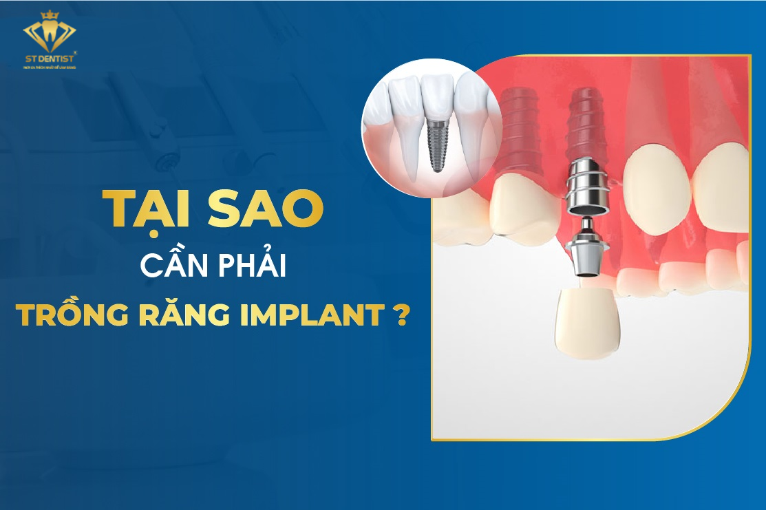 Tại Sao Phải Cấy Ghép Implant【BS.Giải Đáp】