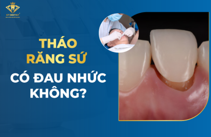 Tháo Răng Sứ Có Đau Không【BS.Giải Đáp】