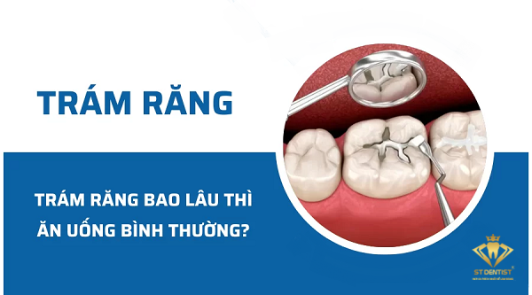 Trám Răng Bao Lâu Thì Ăn Uống Bình Thường【Tìm Hiểu】