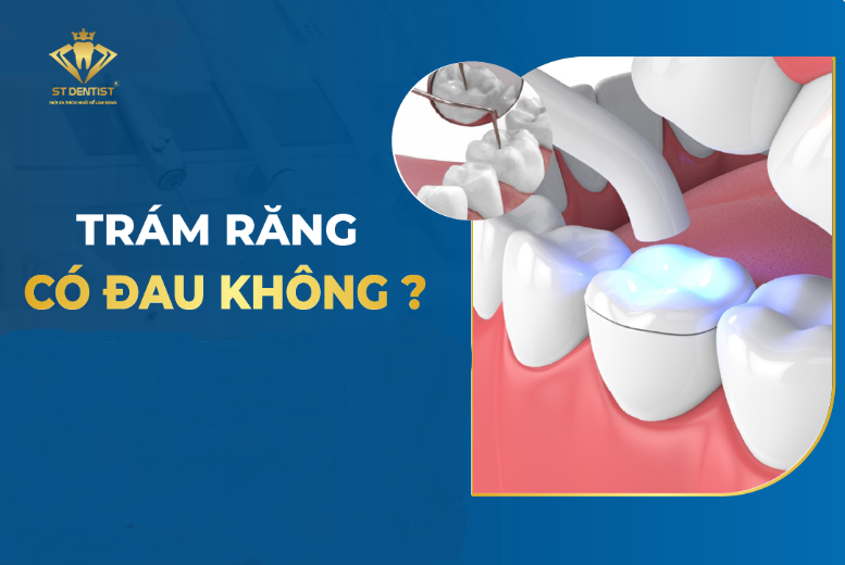 Trám Răng Có Đau Không? Tất Cả Những Điều Bạn Cần Biết