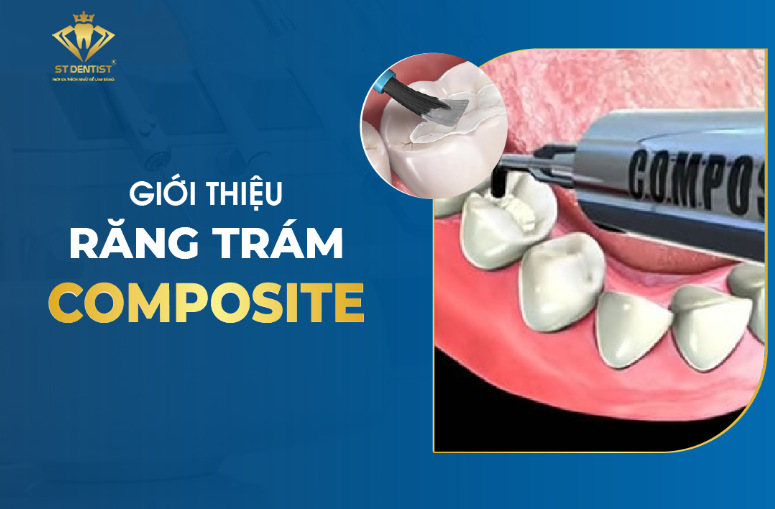 Trám Răng Composite - Giải Pháp Phục Hồi Răng Thẩm Mỹ An Toàn