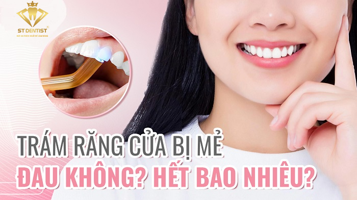 Trám Răng Cửa Bị Mẻ Có Được Không【BS.Giải Đáp】