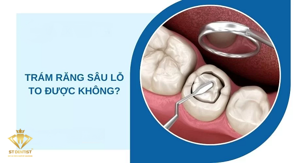 Trám Răng Sâu Lỗ To Được Không【BS.Tư Vấn】