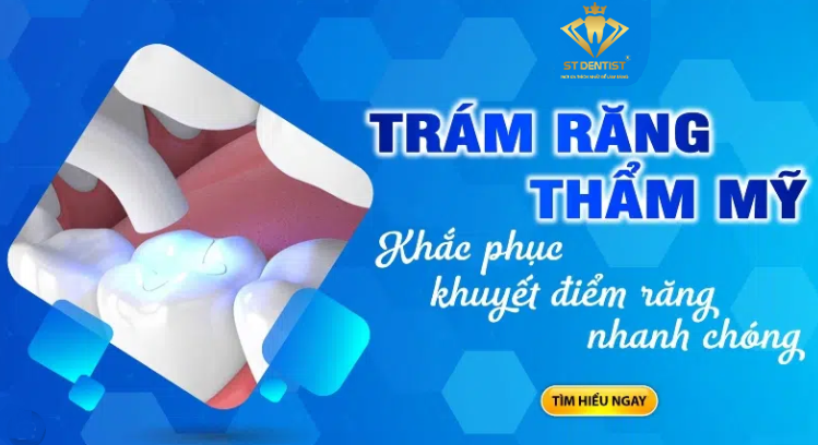 Trám Răng Thẩm Mỹ - Giải Pháp Hoàn Hảo Cho Nụ Cười Rạng Rỡ