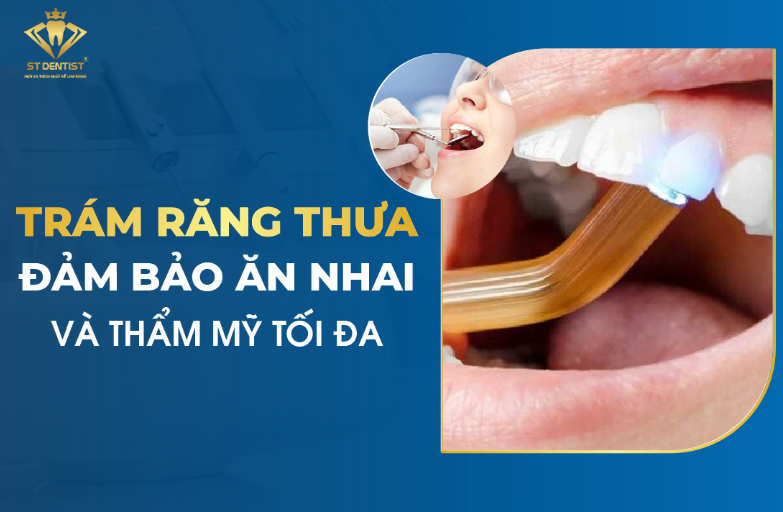 Trám Răng Thưa: Lợi Ích, Chi Phí Và Quy Trình Thực Hiện