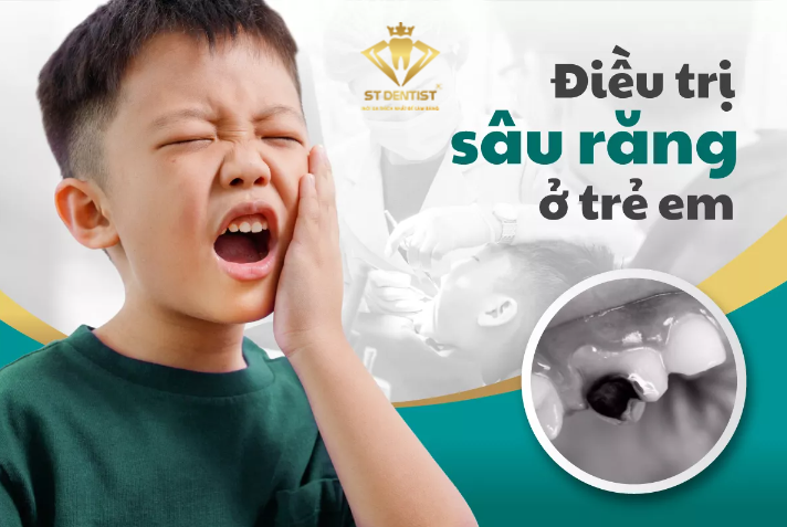 Cách Trị Sâu Răng Ở Trẻ Em Hiệu Quả Và An Toàn