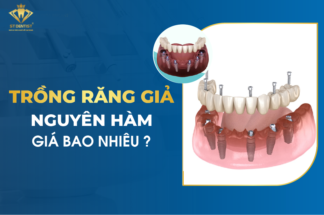 Trồng Răng Giá Nguyên Hàm Giá Bao Nhiêu【Tìm Hiểu】