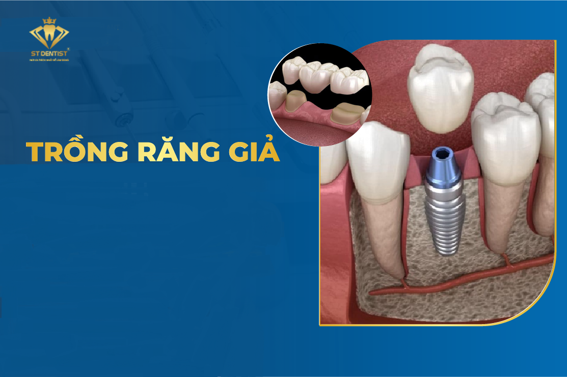 Trồng Răng Giả - Những Điều Bạn Cần Biết