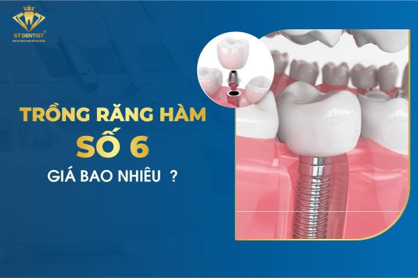 Trồng Răng Hàm Số 6 Giá Bao Nhiêu【Tìm Hiểu】