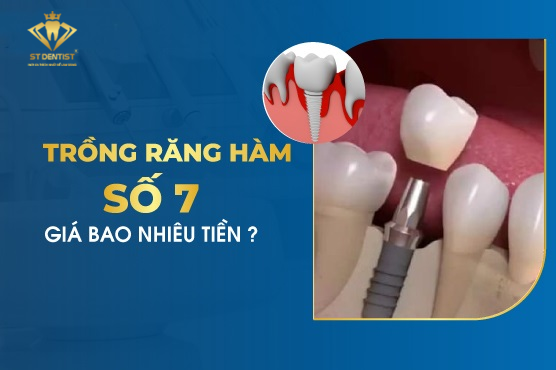 Trồng Răng Hàm Số 7 Bao Nhiêu Tiền【Tìm Hiểu】