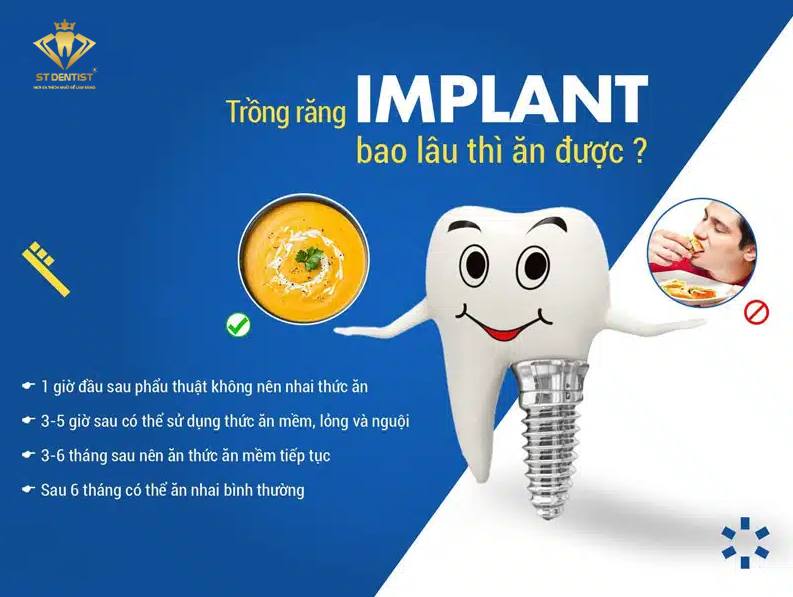 Trồng Răng Implant Bao Lâu Thì Ăn Được【BS.Tư Vấn】