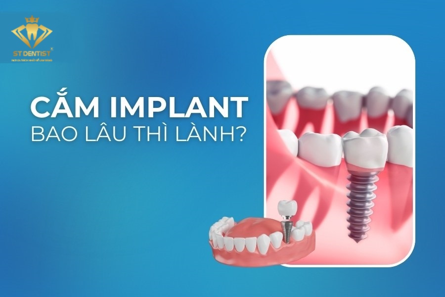 Trồng Răng Implant Bao Lâu Thì Lành【BS.Giải Đáp】